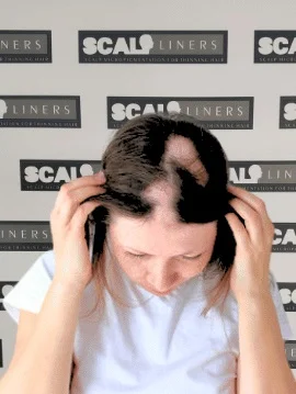 Alopecia scalp micropigmentation treatment result for patchy hair loss in Kent