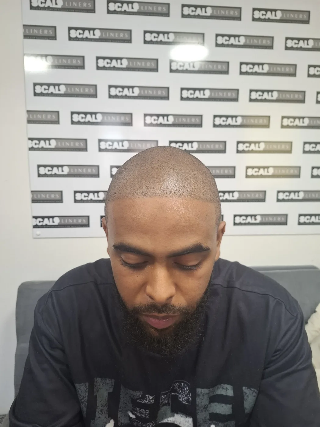 Scalp micropigmentation result for a ScalpLiners client