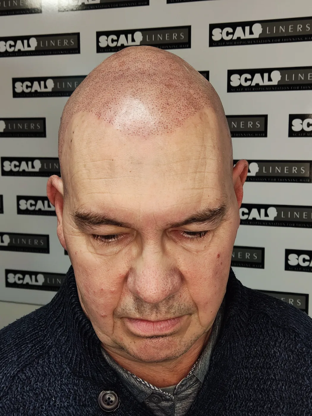 Scalp micropigmentation result on a client at ScalpLiners
