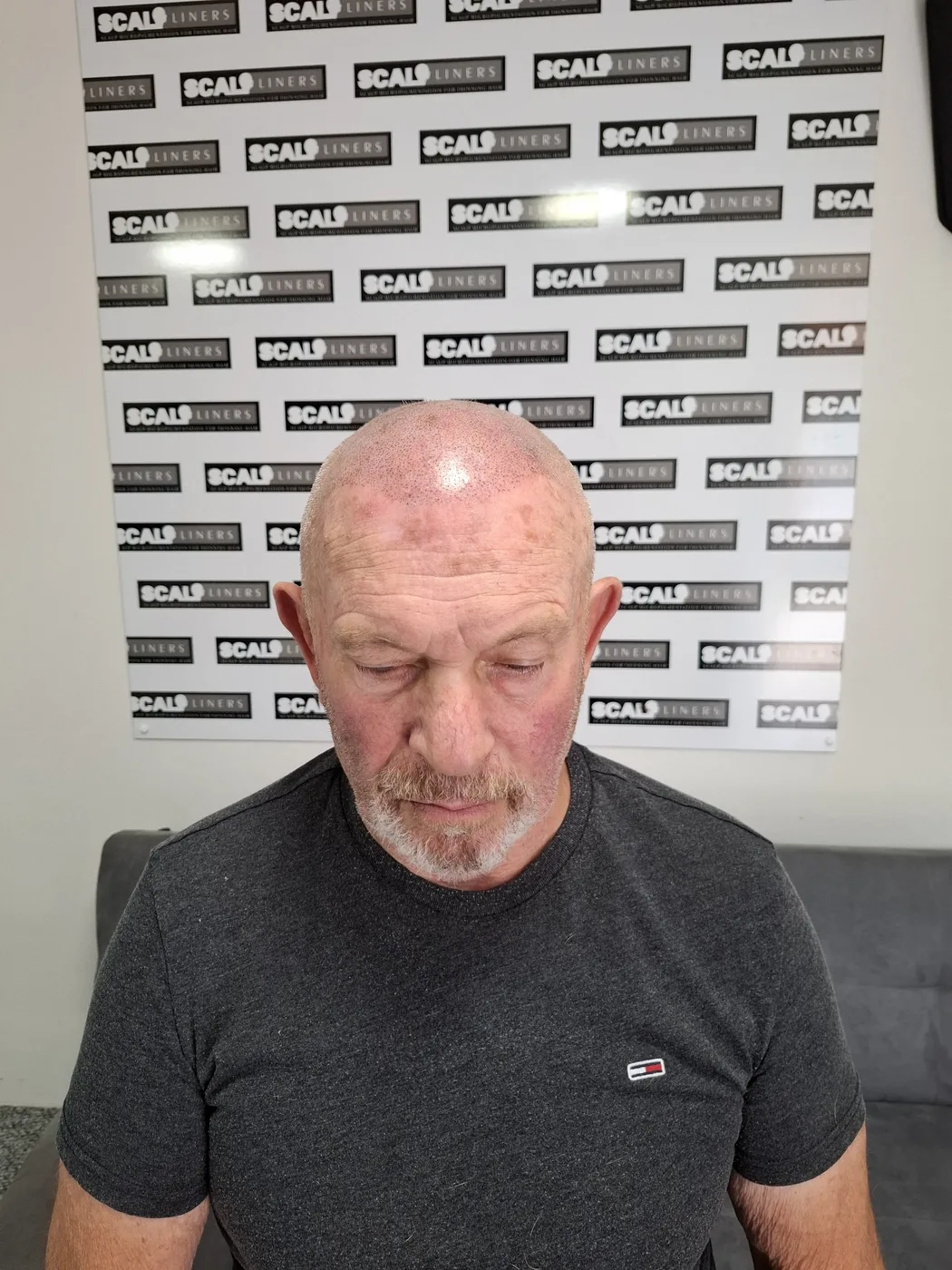 Full head scalp micropigmentation result for male hair loss in Kent