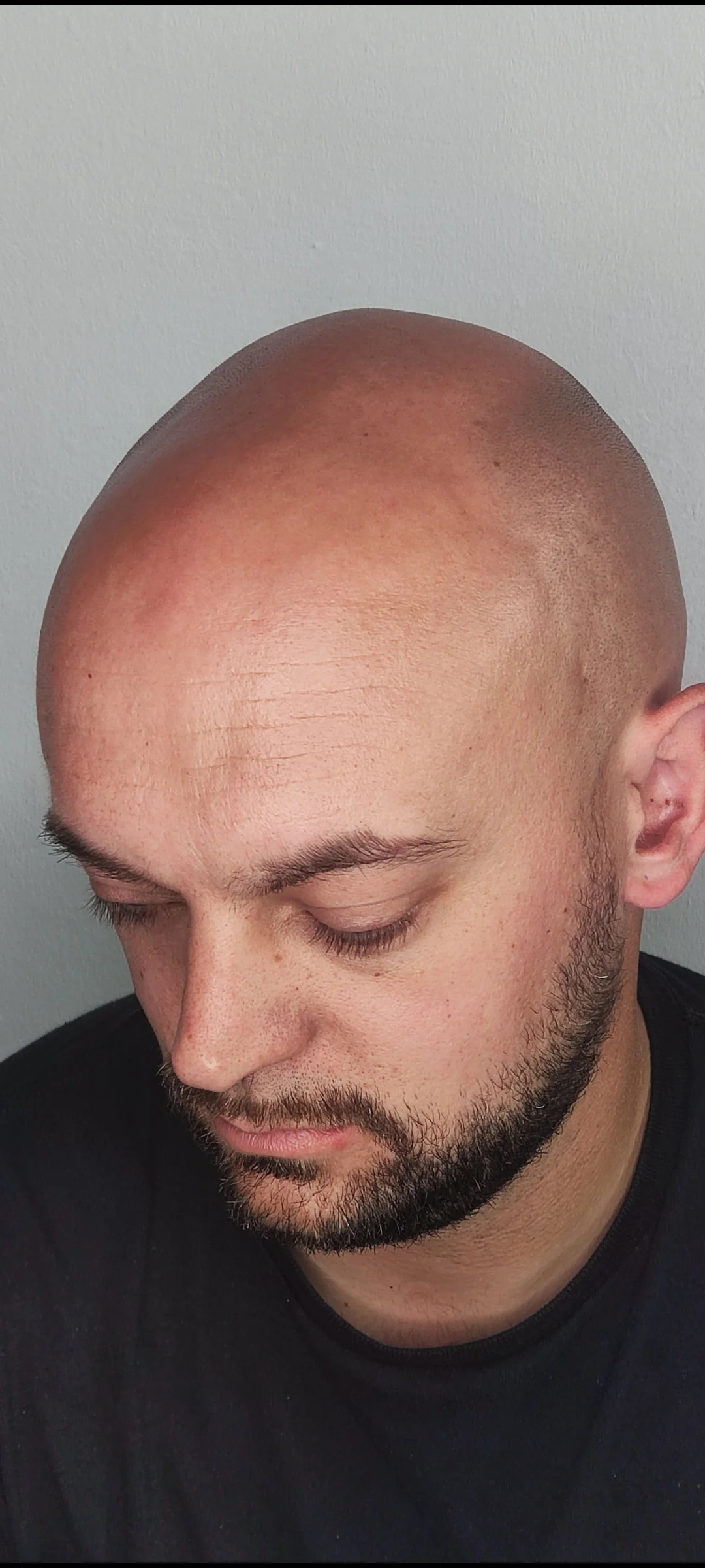 Scalp micropigmentation result for a ScalpLiners client