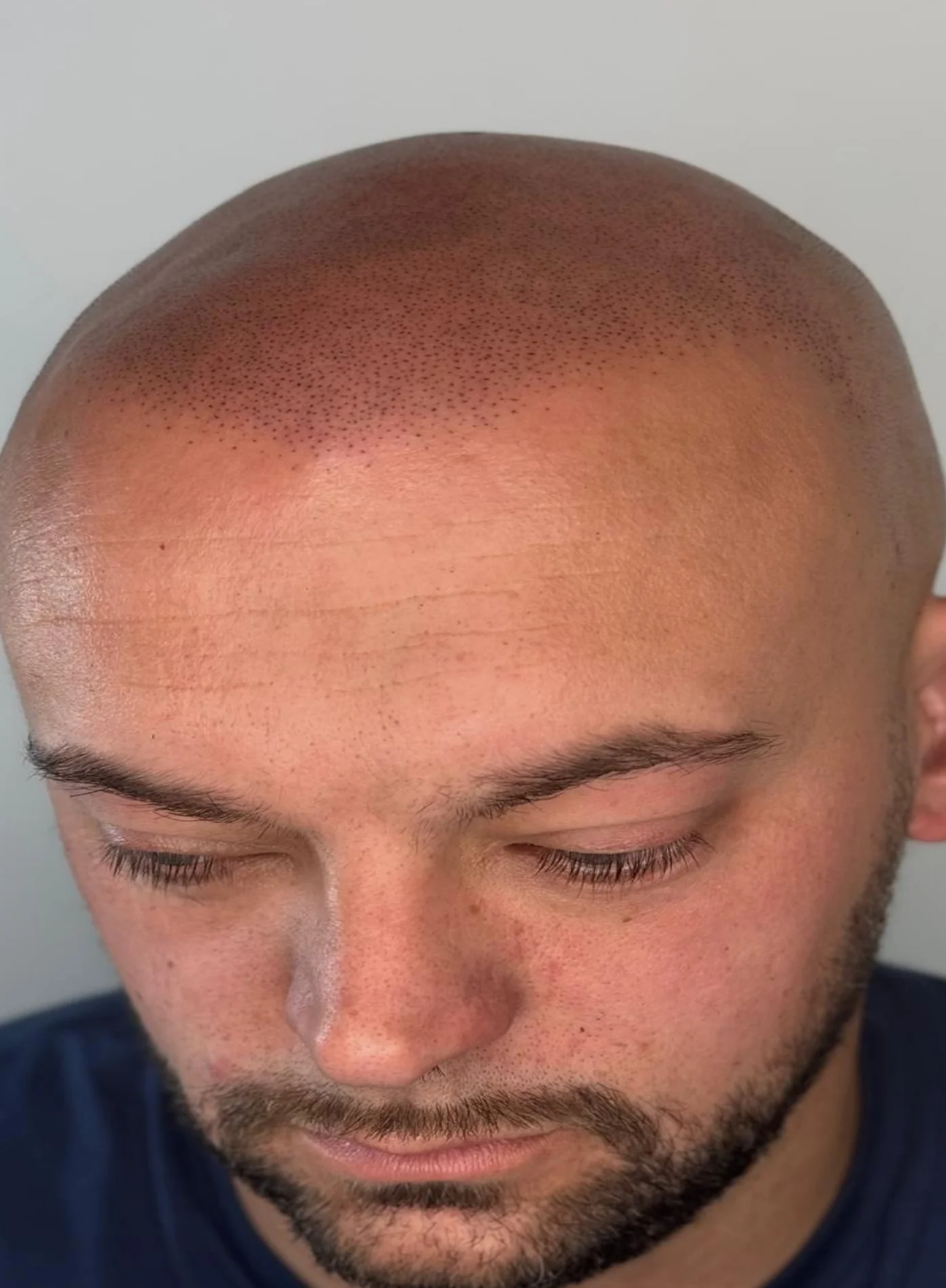 Scalp micropigmentation result for a ScalpLiners client