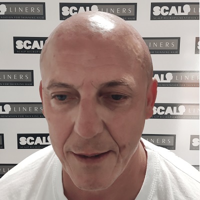 Male pattern baldness treatment in Kent