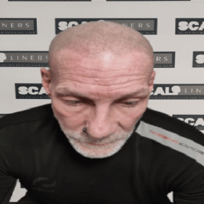Hairline restoration results in Whitstable