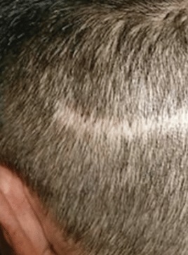  Scar Camouflage Process at Scalpliners
