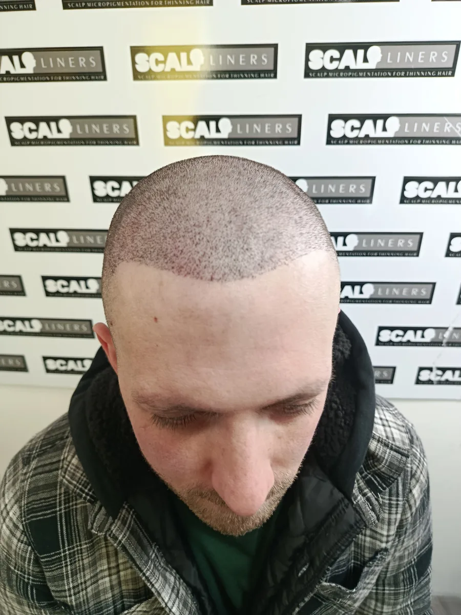 Scalp micropigmentation hairline result for a ScalpLiners client