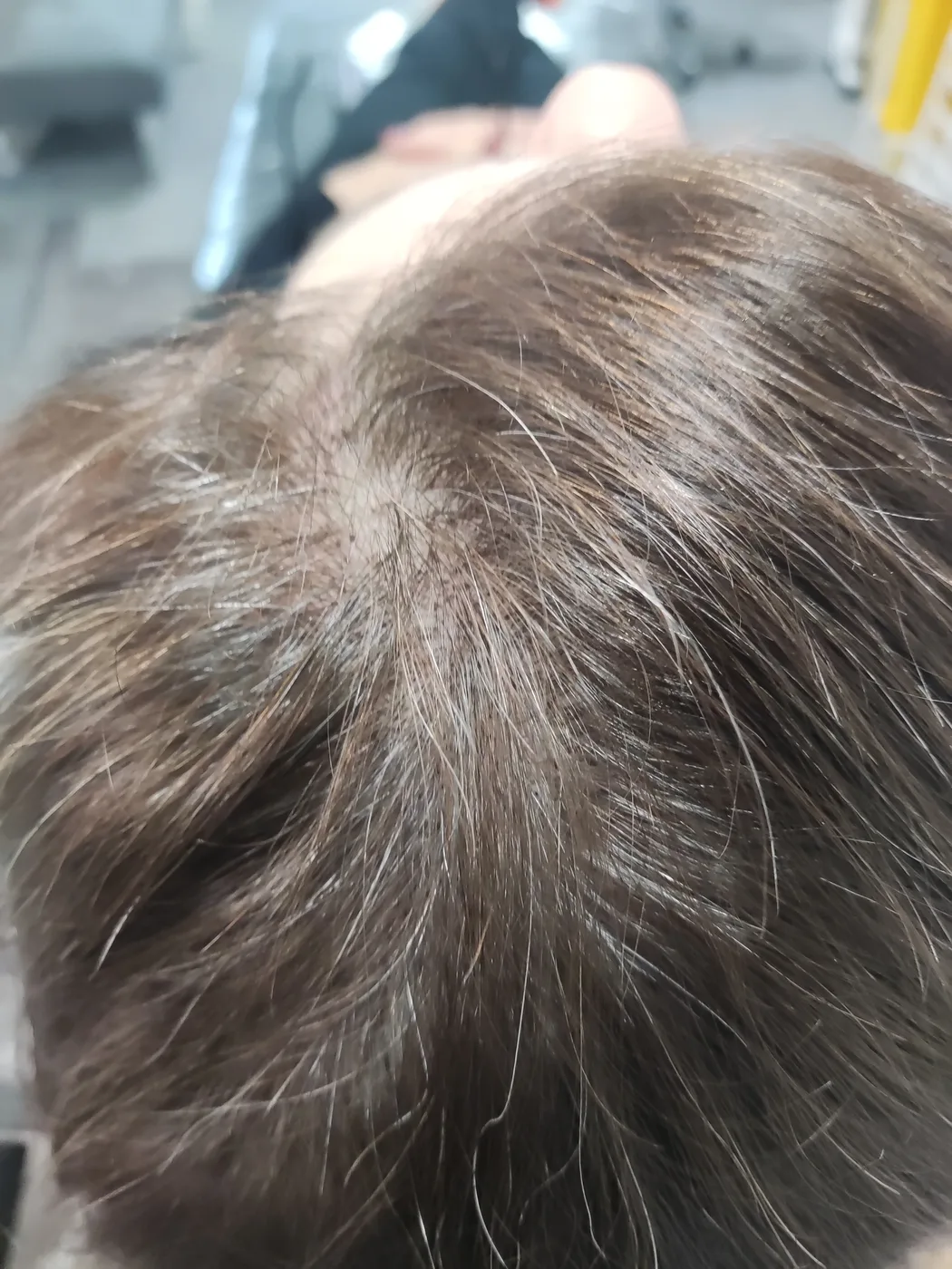 Women's scalp micropigmentation visible scalp reduction result in Kent