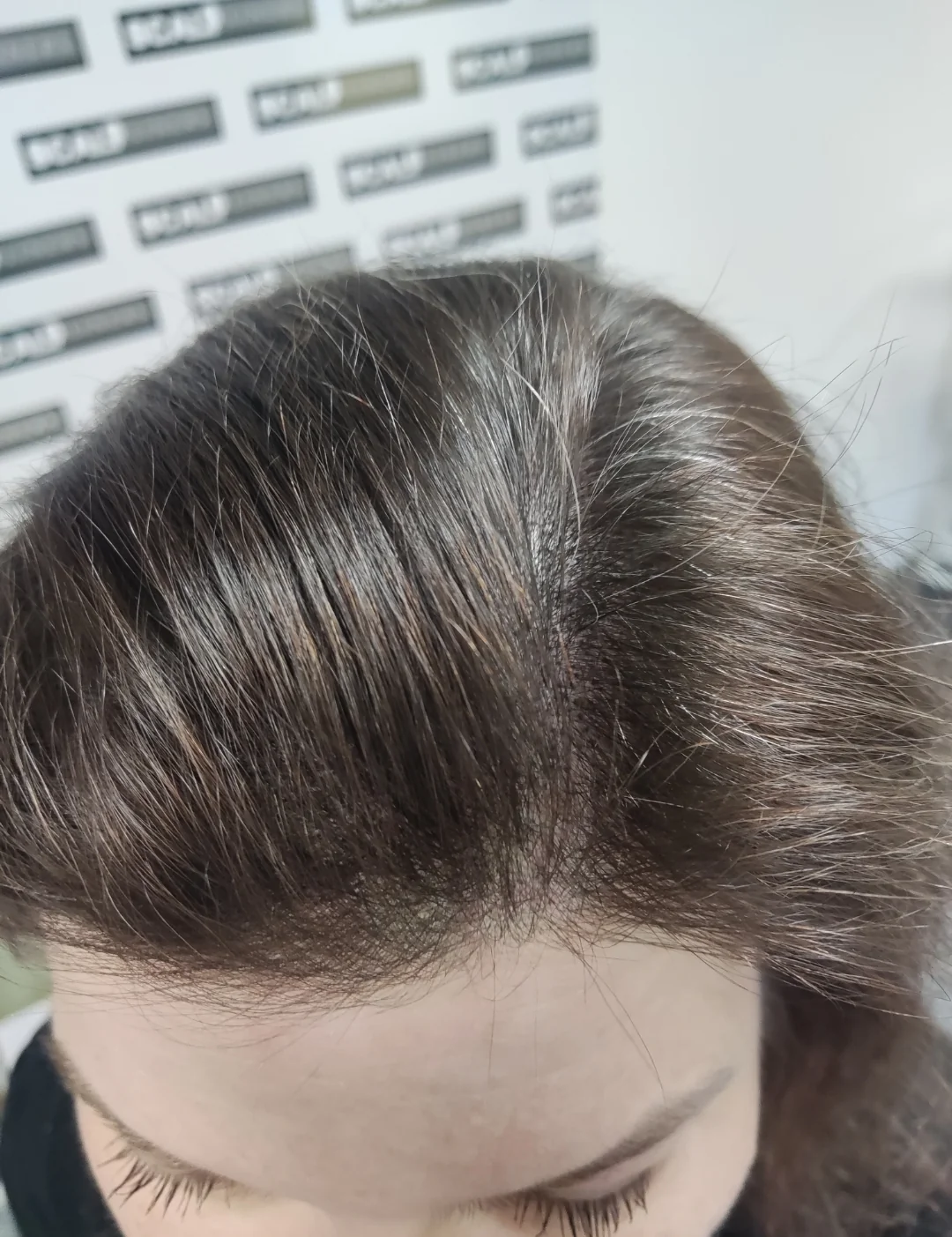 Women's scalp micropigmentation density result showing softer visible scalp in Kent