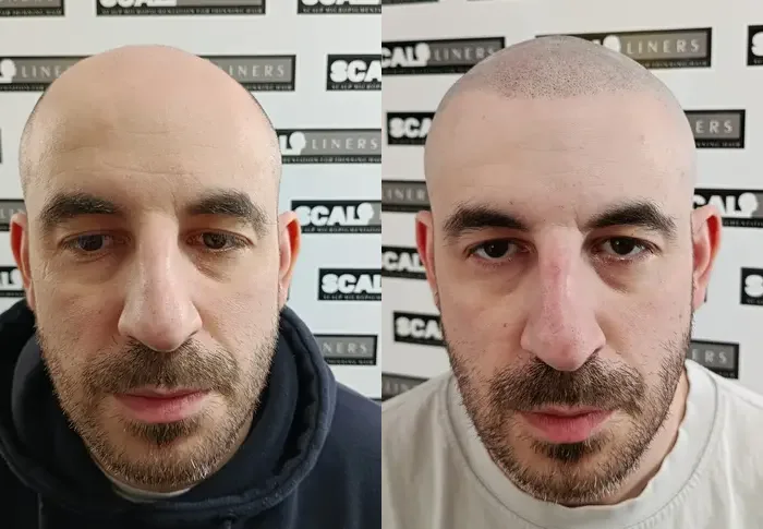 Mike before and after natural scalp micropigmentation result at ScalpLiners Kent