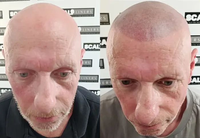 Neil before and after scalp micropigmentation hair loss treatment at ScalpLiners Kent