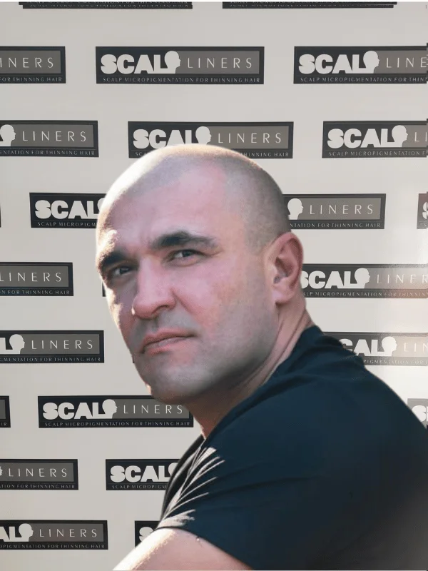 Scalp micropigmentation result for a ScalpLiners client