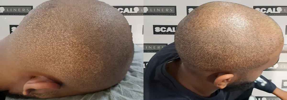 Second hair transplant scar before and after SMP camouflage in Kent