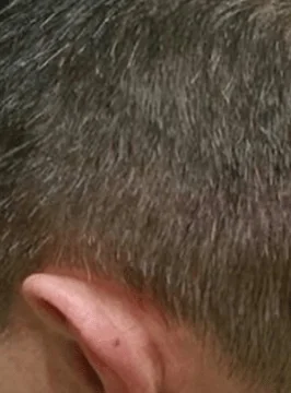 Hair transplant scar camouflage scalp micropigmentation result in Kent