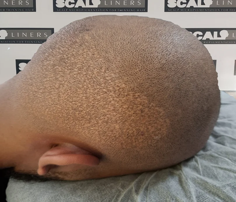 Hair transplant scar camouflage scalp micropigmentation result at ScalpLiners Kent