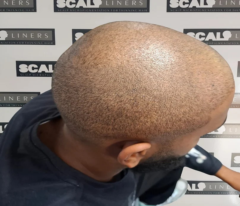 FUE scar camouflage SMP blend result in Kent