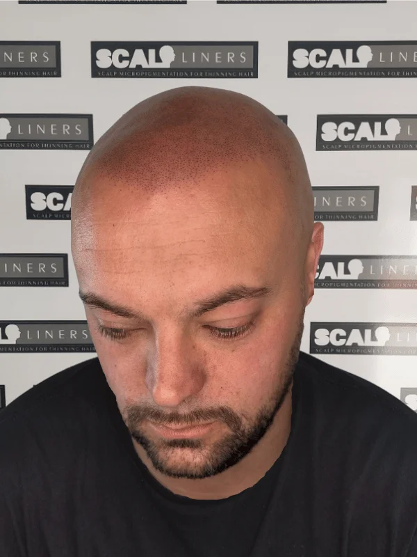 Gary after third scalp micropigmentation session at ScalpLiners Kent