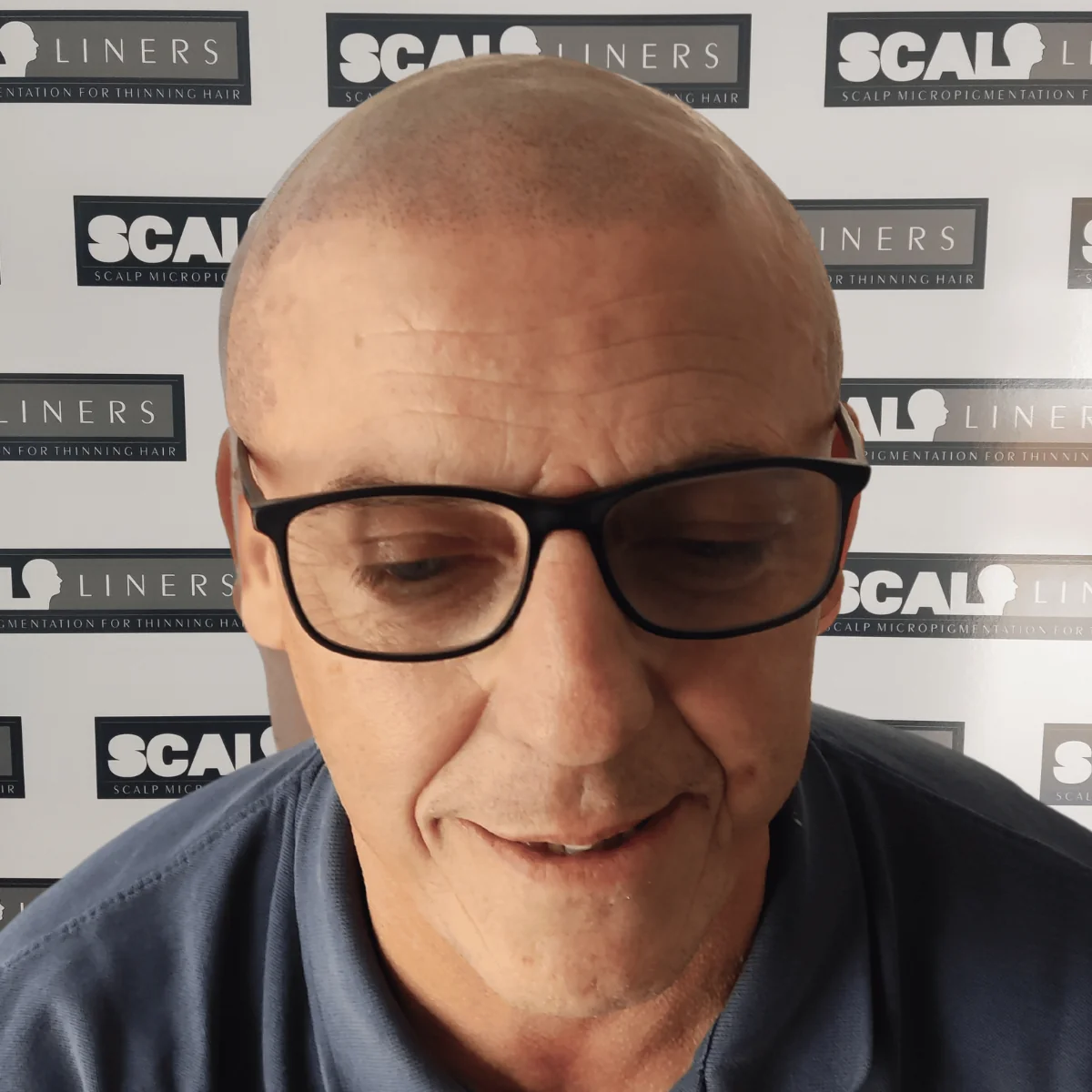 Scalp micropigmentation result for a ScalpLiners client